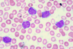 Above: Chronic Lymphocytic Leukemia. Juno Therapeutics is facing a lawsuit just as the company gained permission by the FDA to restart its study for a leukemia drug candidate.