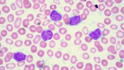 Above: Chronic Lymphocytic Leukemia. Juno Therapeutics is facing a lawsuit just as the company gained permission by the FDA to restart its study for a leukemia drug candidate.