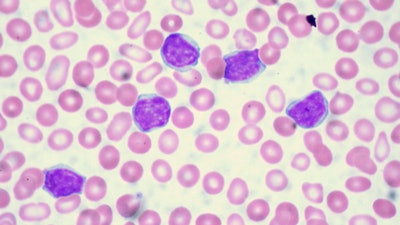 Above: Chronic Lymphocytic Leukemia. Juno Therapeutics is facing a lawsuit just as the company gained permission by the FDA to restart its study for a leukemia drug candidate.