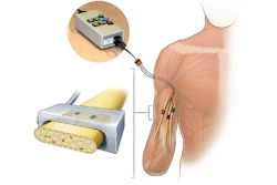 In the HAPTIX system, when pressure sensors on a prosthetic hand worn by a volunteer are engaged, they send signals to a stimulator outside of the volunteer’s body.