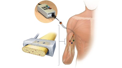 In the HAPTIX system, when pressure sensors on a prosthetic hand worn by a volunteer are engaged, they send signals to a stimulator outside of the volunteer’s body.