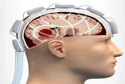 Individual antennas in the system transmit, in sequence, a weak microwave signals through the brain, while other receiving antennas measure the reflected signals. Distinct structures and substances in the brain affect the microwave scattering and reflections in different ways and the received signals provides a complex pattern, as interpreted by using advanced algorithms.