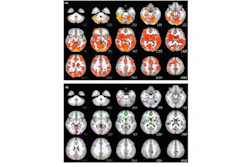 A comparison of MRI brain scans of a bipolar patient (top) and a healthy patient (bottom.)