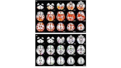 A comparison of MRI brain scans of a bipolar patient (top) and a healthy patient (bottom.)