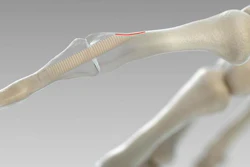 The big advantage of screws made of donated bone material: The donated material completely heals into the bones.