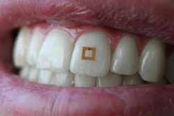 The 2x2 mm sensor monitors ingested fluids and transmits information wirelessly.