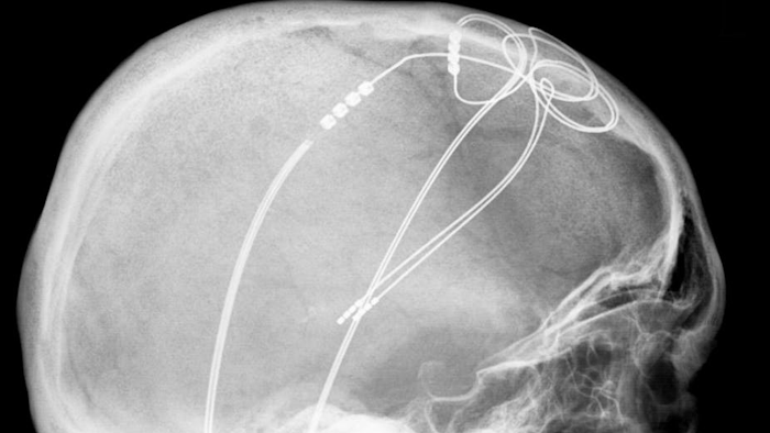 Probes that can transmit electricity inside the skull raise questions about personal autonomy and responsibility.