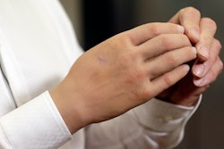 Marco Zambelli wears his prosthetic hand during an interview with the Associated Press in Rome Thursday, May 10, 2018. An Italian government-funded research institute and prosthetic maker unveiled a new robotic hand that they say amputees to grip objects with more precision, and with a mechanical design that will significantly bring down the price of a myoeletric prosthetic hand.
