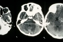 A CT scan showing cancer in the eye.