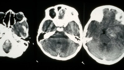 A CT scan showing cancer in the eye.