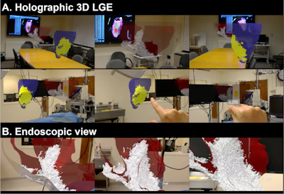 Demonstration of the 3D holographic visualization of the voxel-wise 3D scar rendering and scar projected endocardial surface mesh from 3D LGE data that are generated based on the proposed framework.