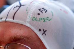 A patient's head cap is marked to pinpoint an area of the brain to use the transcranial magnetic stimulation at the VA Palo Alto Health Care System on Wednesday, Nov. 7, 2018, Palo Alto, Calif. The device, which claims to treat depression by beaming rapid-fire bursts of magnetic energy into the brain’s prefrontal cortex, was approved by the Food and Drug Administration in October 2008, despite receiving a negative review by federal health advisers.