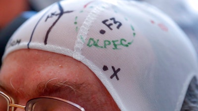 A patient's head cap is marked to pinpoint an area of the brain to use the transcranial magnetic stimulation at the VA Palo Alto Health Care System on Wednesday, Nov. 7, 2018, Palo Alto, Calif. The device, which claims to treat depression by beaming rapid-fire bursts of magnetic energy into the brain’s prefrontal cortex, was approved by the Food and Drug Administration in October 2008, despite receiving a negative review by federal health advisers.