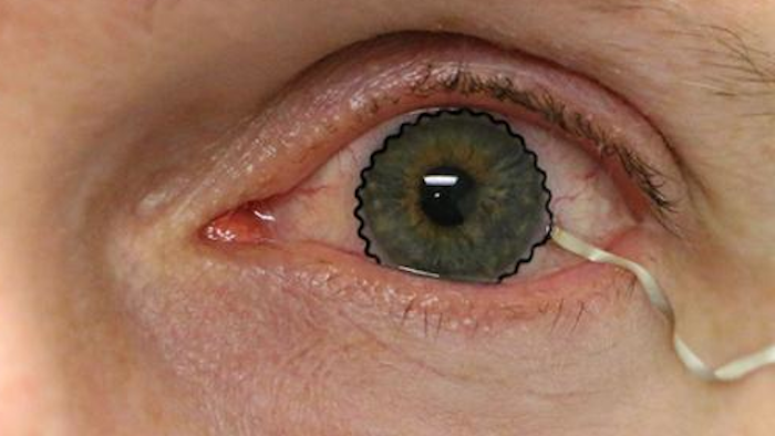 New contact lens technology to help diagnose and monitor medical conditions may soon be ready for clinical trials. The team enabled commercial soft contact lenses to be a bioinstrumentation tool for unobtrusive monitoring of clinically important information associated with underlying ocular health conditions.