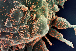 A human cell (greenish blob) is heavily infected with SARS-CoV-2 (orange dots), the virus that causes COVID-19, in this colorized microscope image.