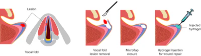 Illustration shows the use of injectable hydrogel as an implant to fill a wound and to restore the voice.