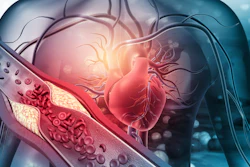 The Elucid platform is an FDA-Cleared and CE-Marked software to objectively quantify plaque morphology.