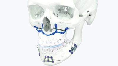 The new facility in Plymouth, Michigan 3D prints personalized titanium cranio-maxillofacial (CMF) implants used for facial reconstructive surgery.
