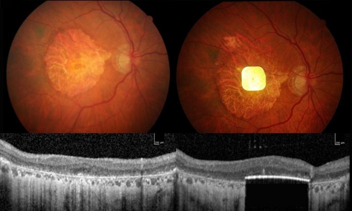Image of the chip in a patient’s eye.
